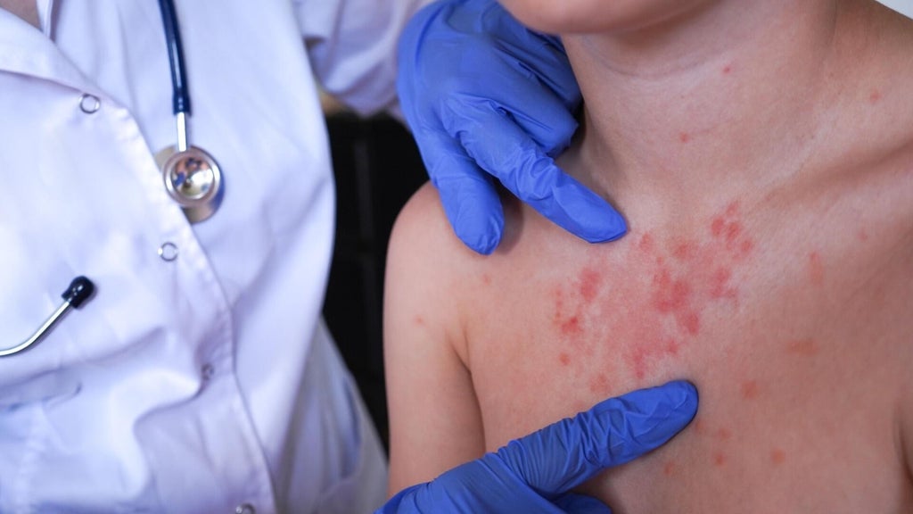 Minnesota's 80 measles cases this year are the most since 1990, health officials say — Hopkins Health news